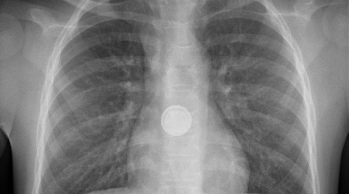 Röntgenbild des Oberkörpers, eine Knopfbatterie befindet sich im Brustkorb.