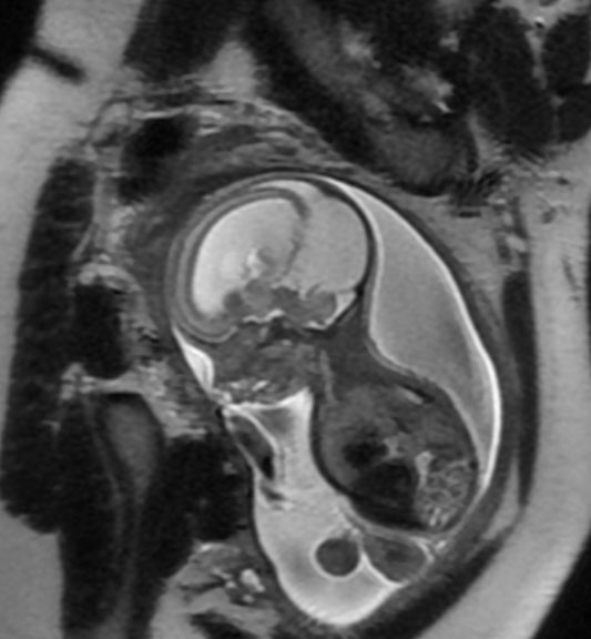 MRI eines Fetus mit Hydrozephalus