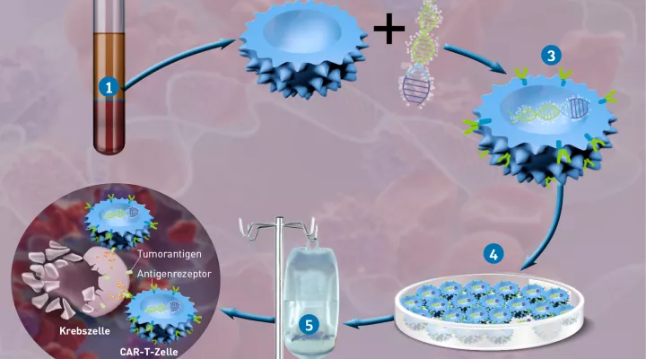Illustration der Abfolge der Car-T-Zell-Therapie