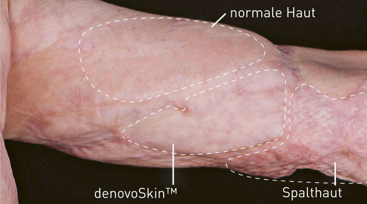 denovoSkin™, verheilt, im Vergleich zu Spalthaut und natürlich verheilter («normaler») Haut