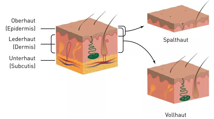 Abbildung Spalthaut und Vollhaut