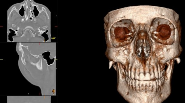 Knochenbildgebung im MRI