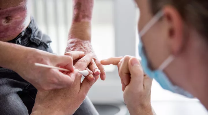 Dr. Sophie Böttcher pflegt brandverletzte Hand von Patient. 