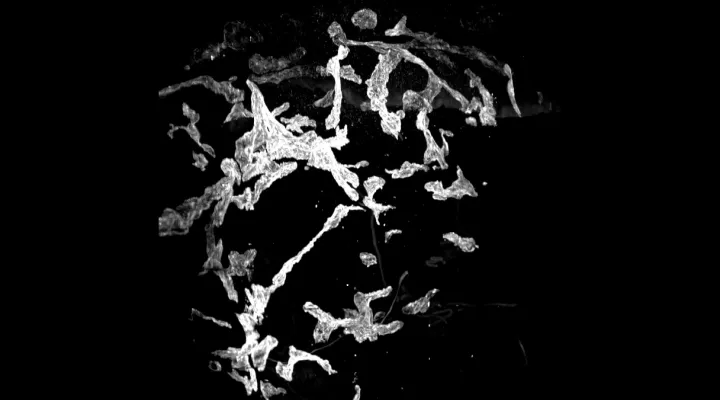 3D-Rekonstruktion lymphödematöser Haut