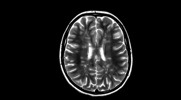 CT Scan eines Kindes, das an Multiple Sklerose erkrankt ist