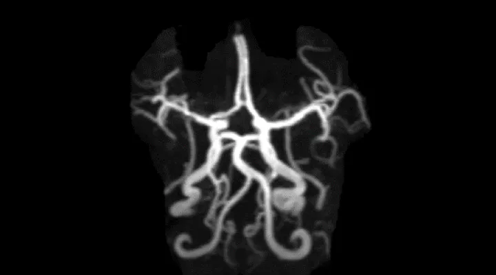 CT Scan der Blutgefässe eines kindlichen Gehirns mit vaskulärer Erkrankung
