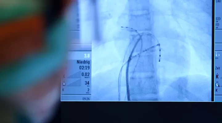 Ein Röntgenbild, auf welchem Drähte im Körper zu sehen sind.