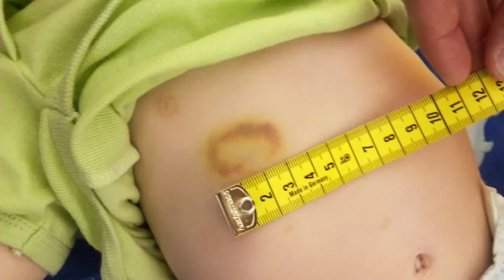 Kind mit Hämatom bei Kinderschutz