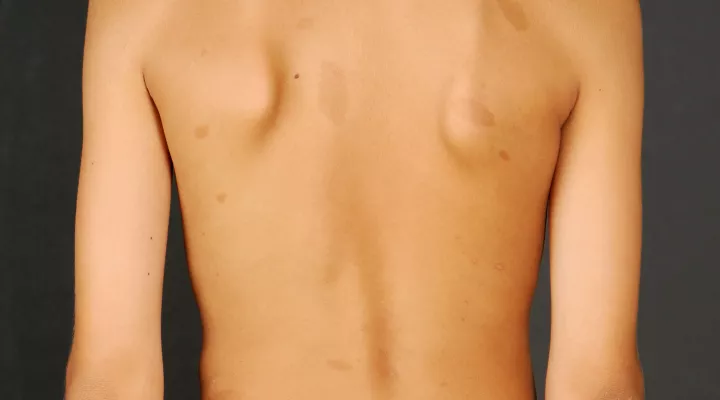 Neurokutane Erkrankungen, NF, Neurofibromatose