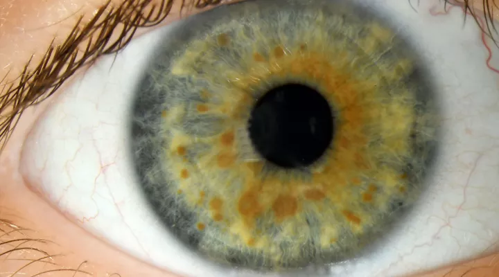 Neurokutane Erkrankungen, NF, Neurofibromatose