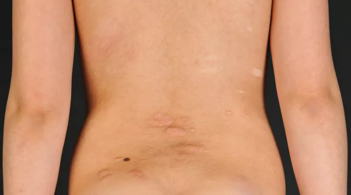 Neurokutane Erkrankungen, white spots und Shagreen