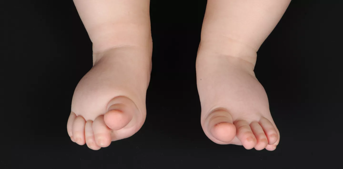 Füsse und Unterschenkel einer Person mit Lymphödemen. Der linke Fuss und Unterschenkel sind geschwollen.