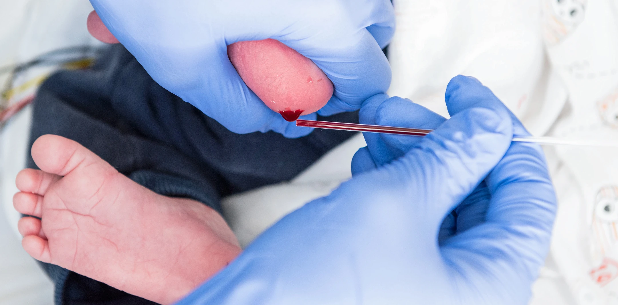 Am Fuss eines Neugeborenen wird Blut für das Neo-Screening abgenommen
