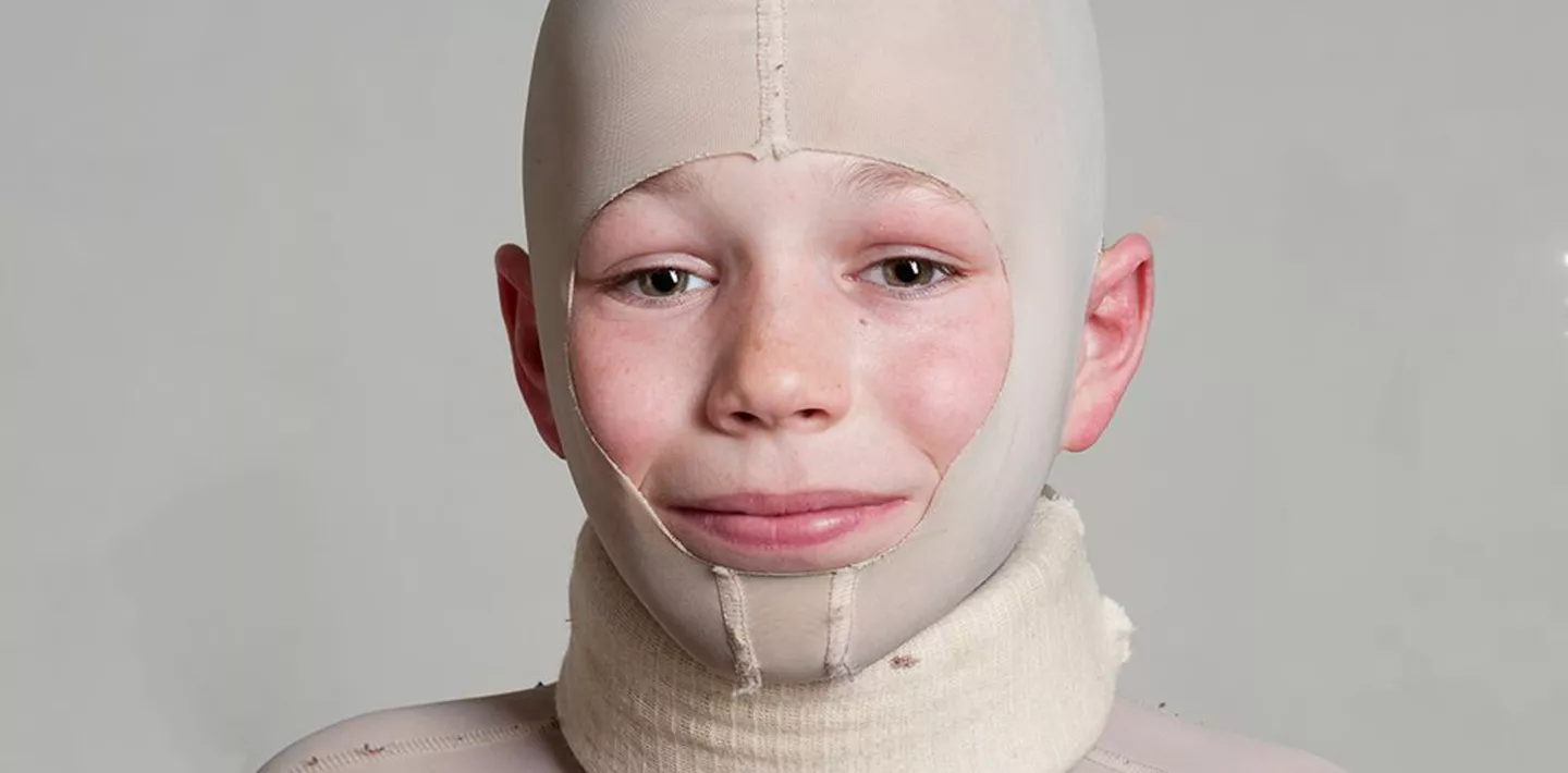 Brandverletzte Kinderhaut Kinderspital Zürich