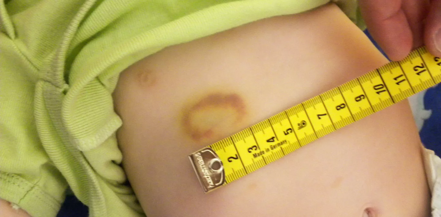 Kind mit Hämatom bei Kinderschutz