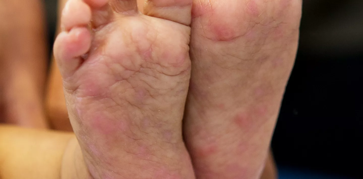 Krätze, auch Skabies genannt, ist eine durch Krätzmilben verursachte Hautkrankheit