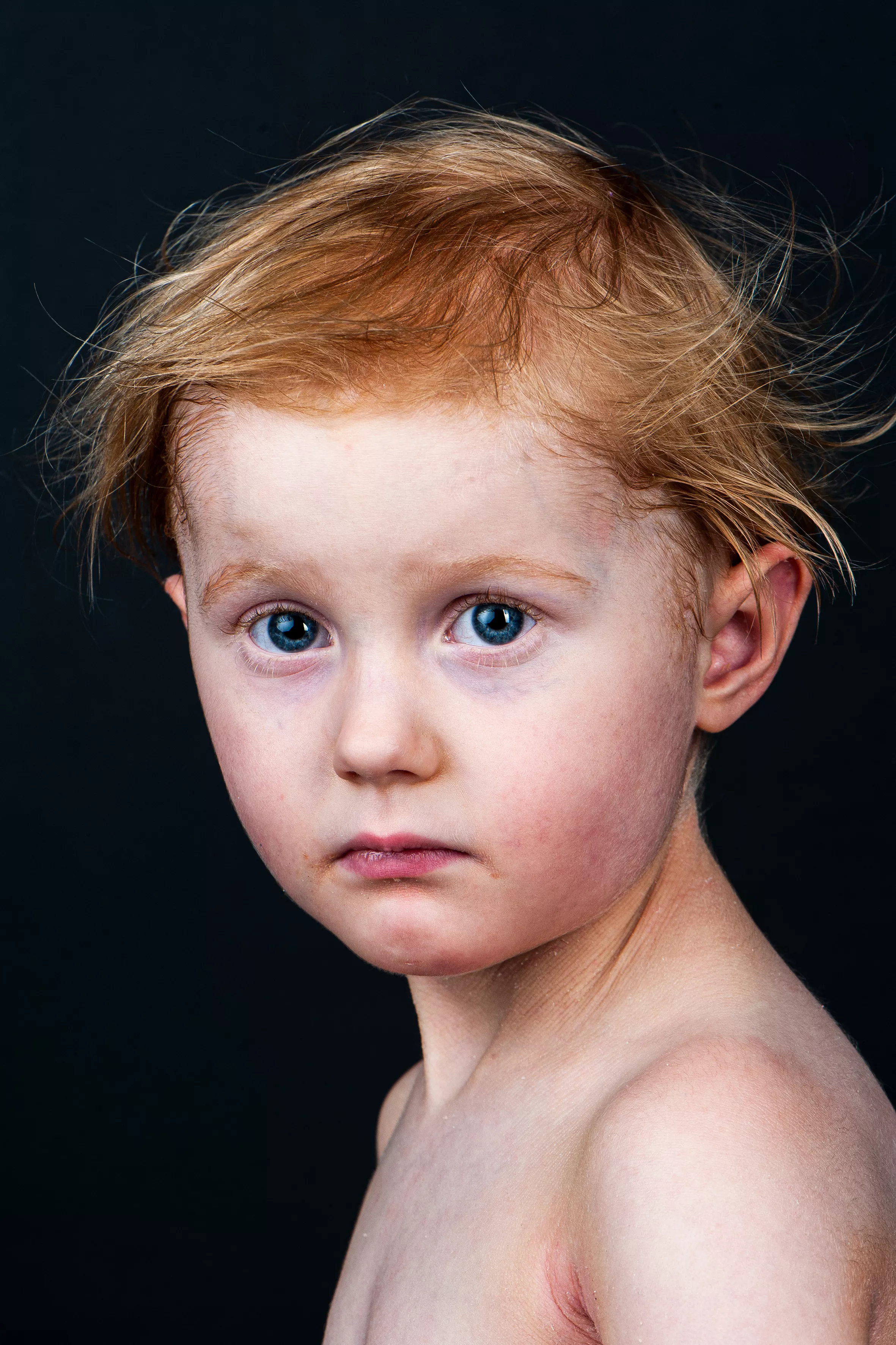 Ein Mädchen mit einer Hauterkrankung schaut in die Kamera während die Fotografin die Aufnahme für die Dermatologie anschafft die 