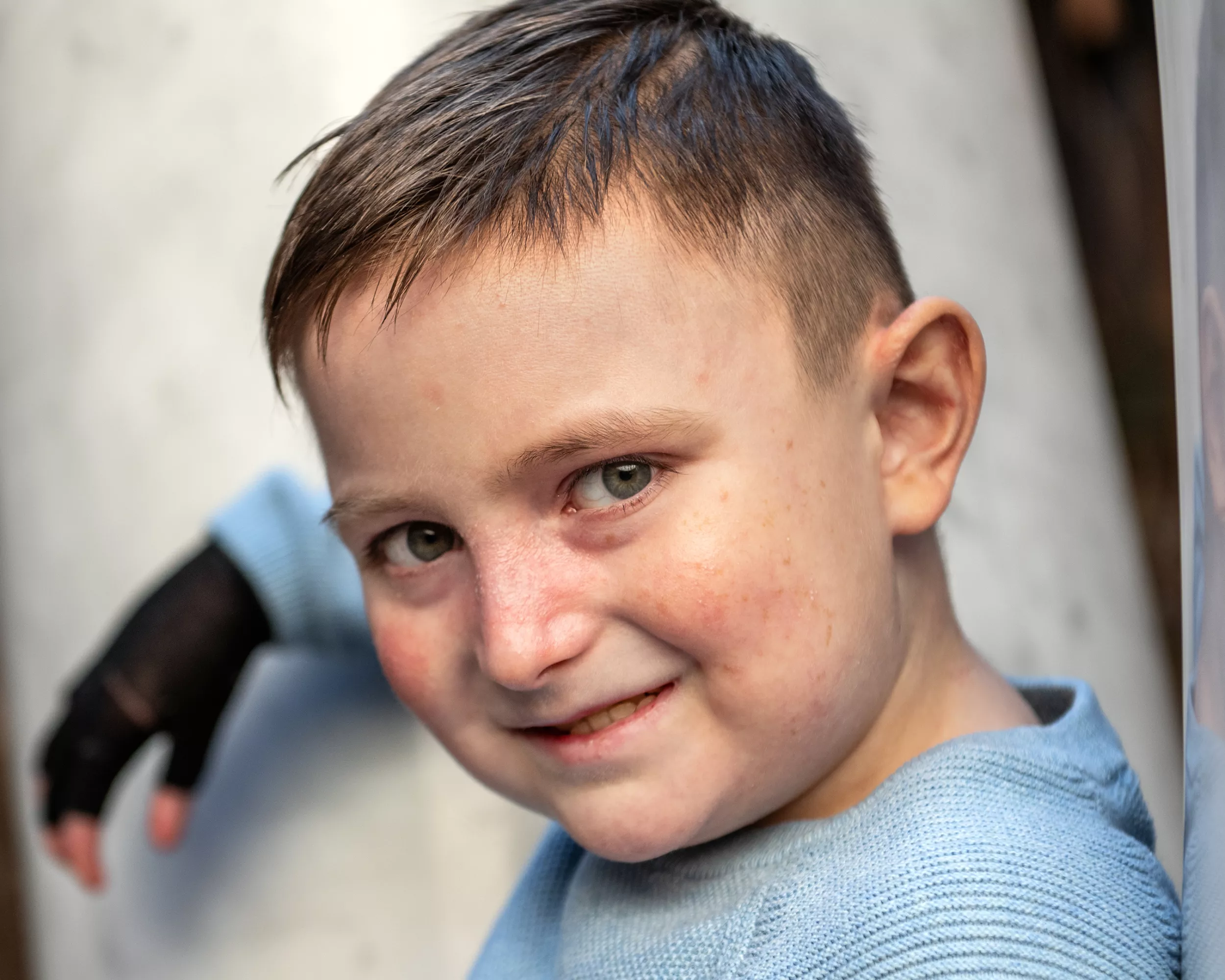 Ein Patient mit Epidermolysis Bullosa lächelt in die Kamera. 