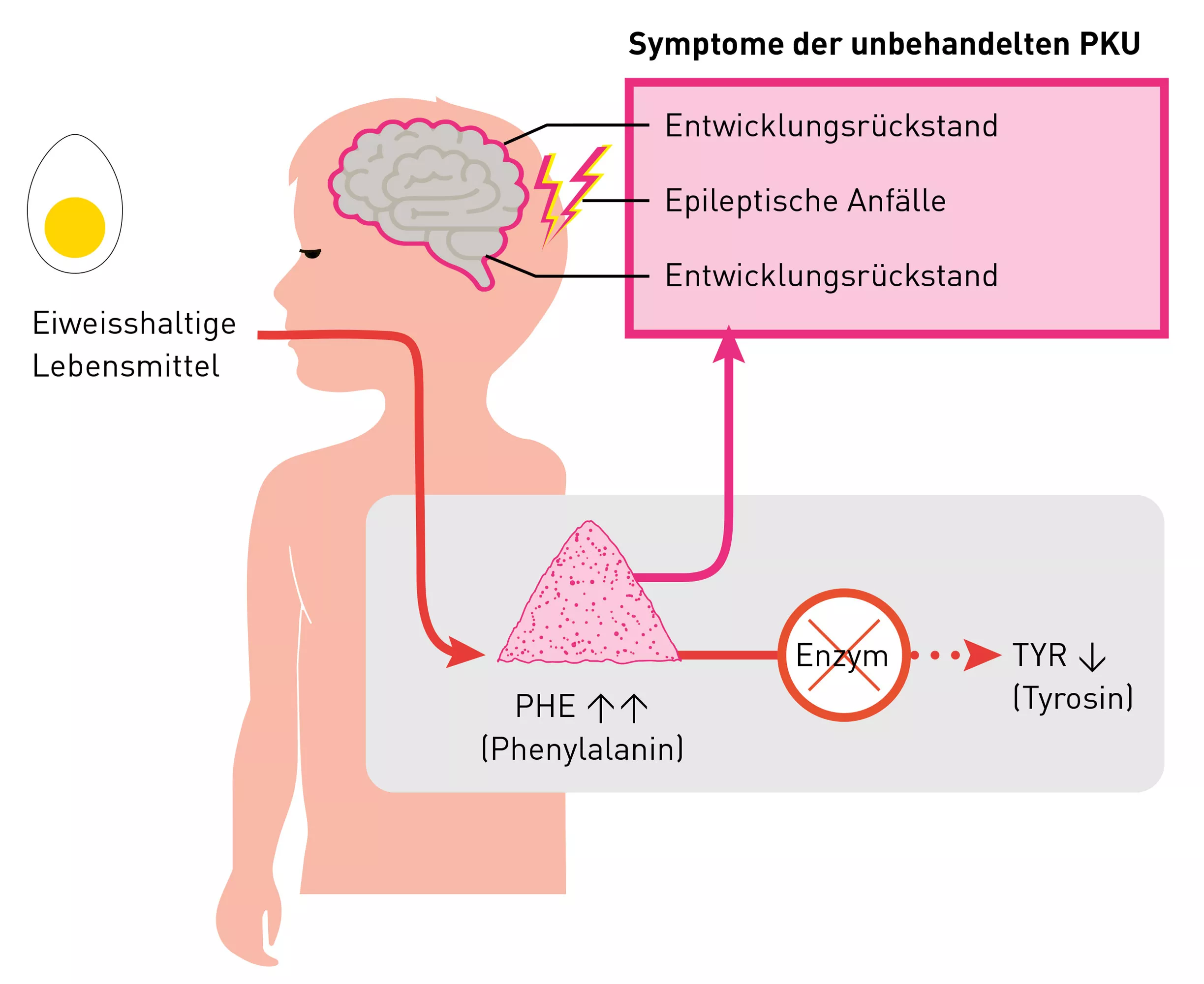 Abbildung Stoffwechselstörung des Vergiftungstyps Phenylketonurie