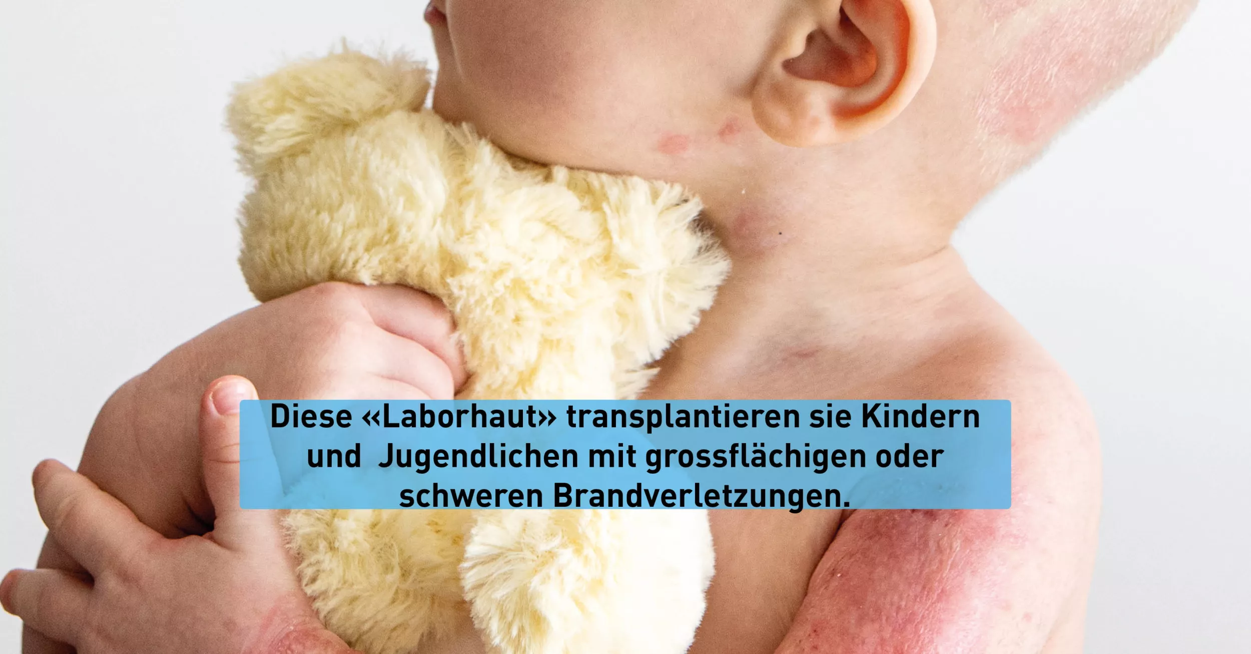 Der Oberkörper eines Babys mit Verbrennungen am Arm ist zu sehen. Das Baby hält ein Stofftier in den Armen.