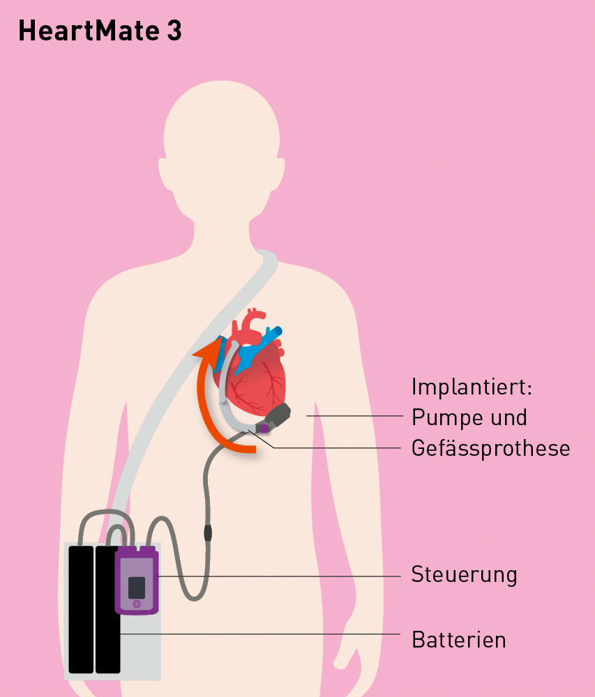 Funktionsweise HeartMate 3 mit implantierter Pumpe und Gefässprothese sowie Steuerung und Batterien
