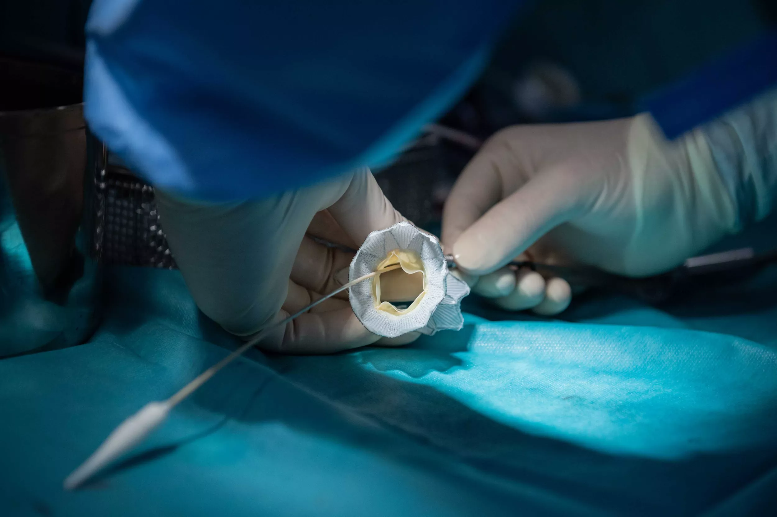 Ein selbstexpandierendes Metallgerüst mit einer eingenähten biologischen Herzklappe