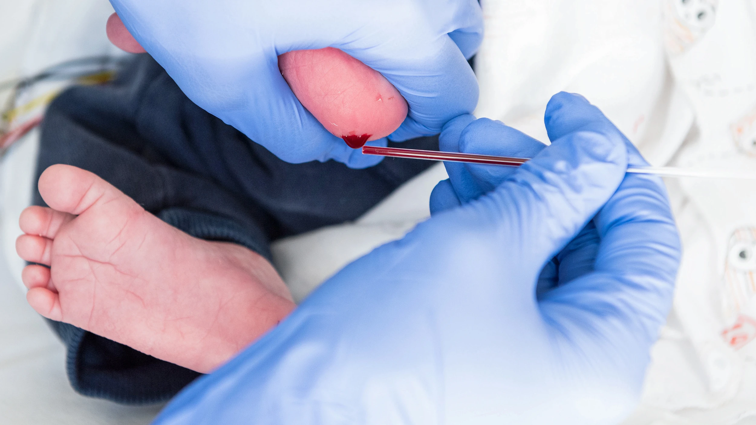 Am Fuss eines Neugeborenen wird Blut für das Neo-Screening abgenommen