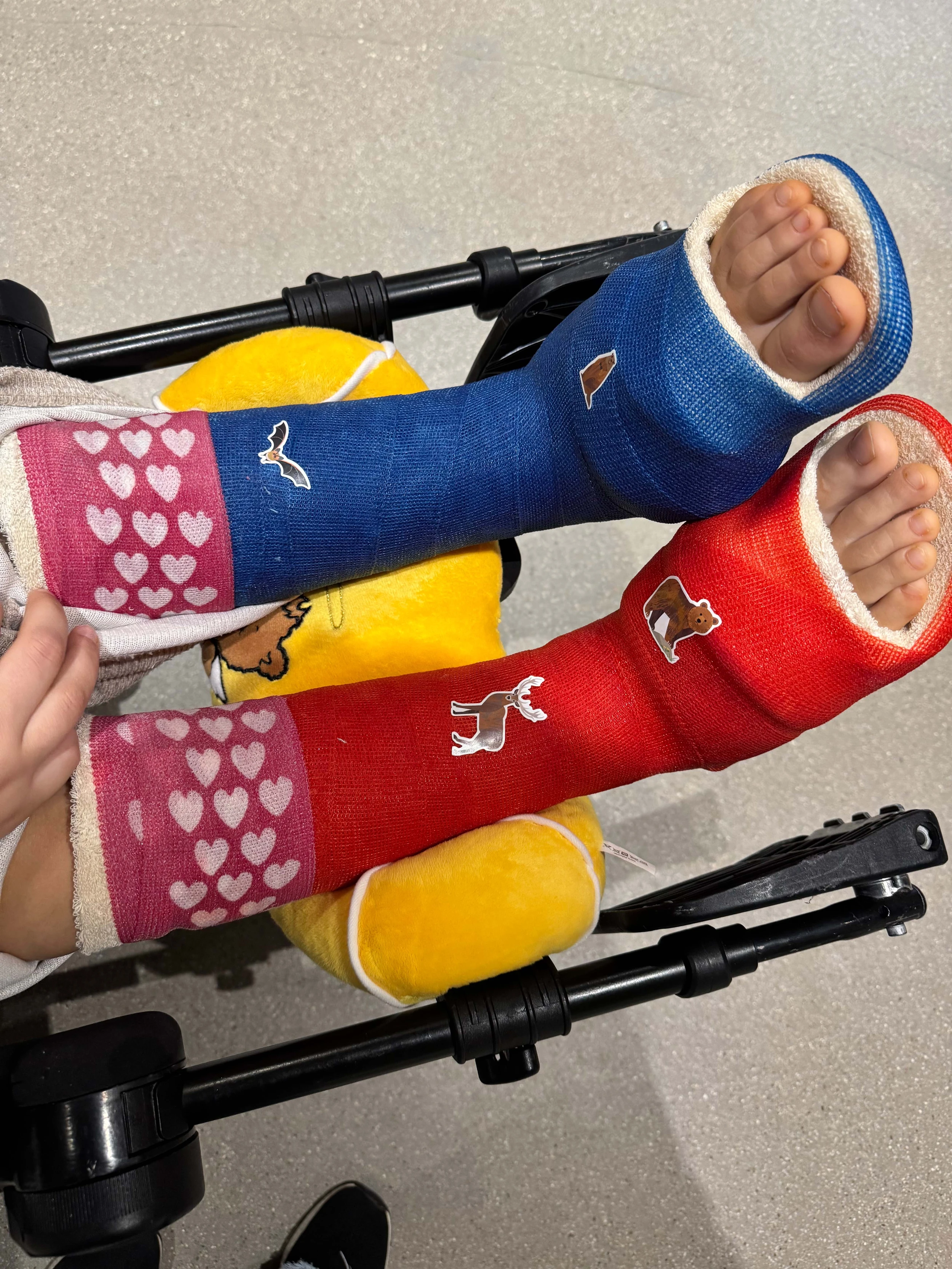 Patientin Tabitha sitzt im Rollstuhl mit zwei bunten Gipsverbänden an den Beinen.