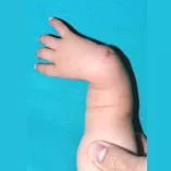 Handchirurgie, radiale longitudinale Fehlbildung mit Radius- und Daumenhypoplasie