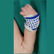 Handchirurgie, radiale longitudinale Fehlbildung mit Radius- und Daumenhypoplasie