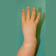 Handchirurgie, radiale longitudinale Fehlbildung mit Radius- und Daumenhypoplasie, nach Operation