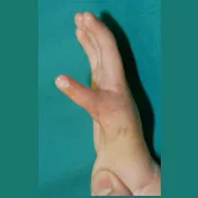Handchirurgie, radiale longitudinale Fehlbildung mit Radius- und Daumenhypoplasie, nach Operation