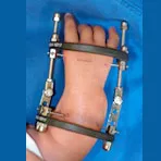 Handchirurgie, radiale longitudinale Fehlbildung mit Radius- und Daumenhypoplasie, mit Schiene