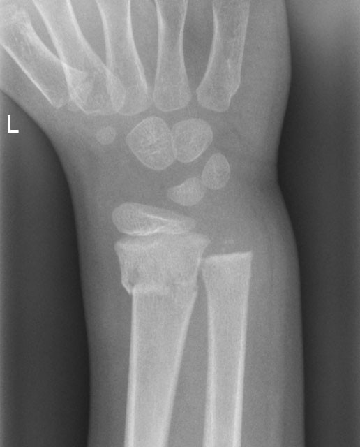 Röntgenbild: Vorderarmfraktur, links