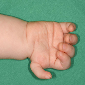 Handchirurgie, Kinderhand mit Unterentwicklung des Daumens