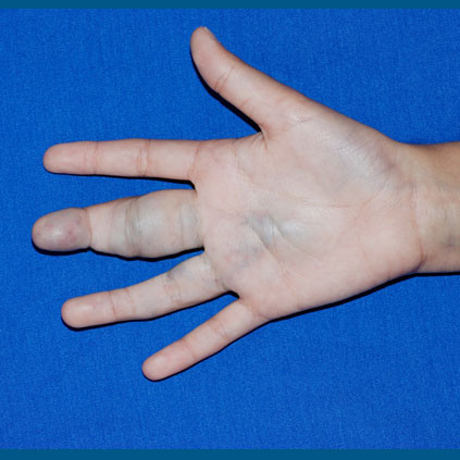 Handchirurgie, rechte Hand mit Gefaessmalformation