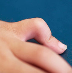 Handchirurgie, Kamptodaktylie kleiner Finger