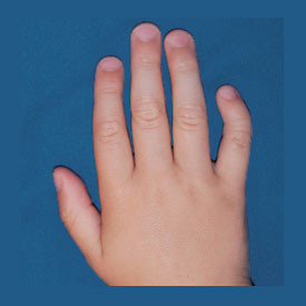 Handchirurgie, rechte Hand mit Klinodaktylie kleiner Finger
