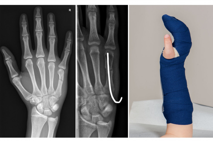 Handchirurgie, Verletzung, Fraktur Finger, Röntgenbilder, Hand in Gips
